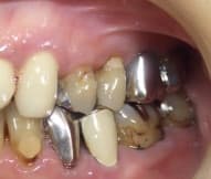 南館歯科クリニックのブログ-左上奥歯