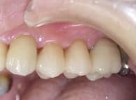 南館歯科クリニックのブログ-左上奥歯　セラミック