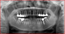 南館歯科クリニックのブログ-インプラント
