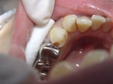 南館歯科クリニックのブログ-ダイレクト治療前