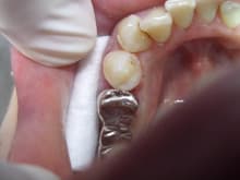 南館歯科クリニックのブログ-ダイレクト治療後