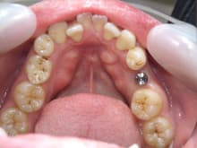 南館歯科クリニックのブログ-インプラント治療